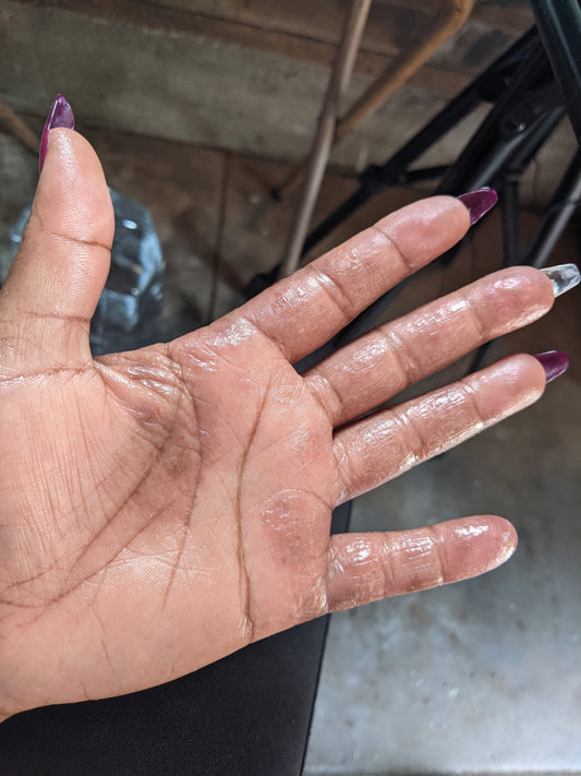 Best Skincare Tips for Eczema-Prone Skin